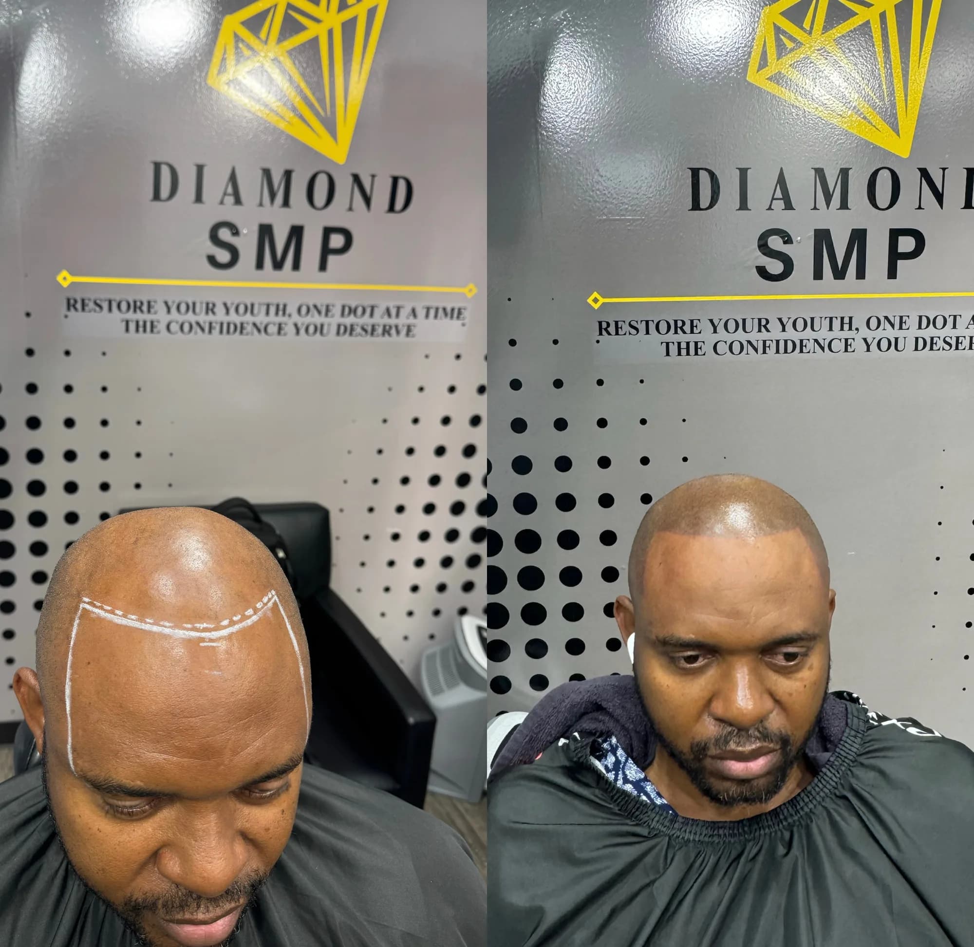 Scalp micropigmentation progression from start to session three