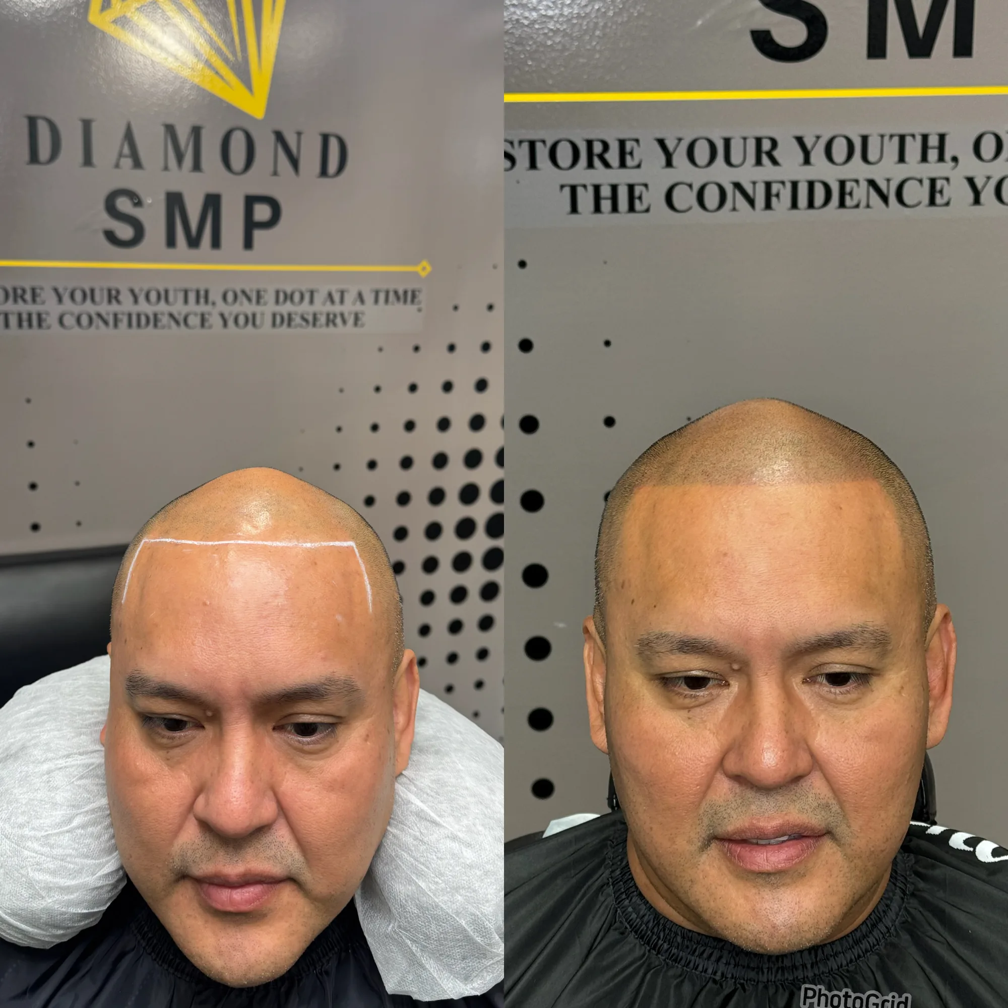 Hairline Result