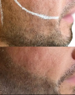 Before and after scar camouflage on jawline