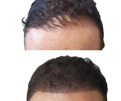 Before and after hairline restoration
