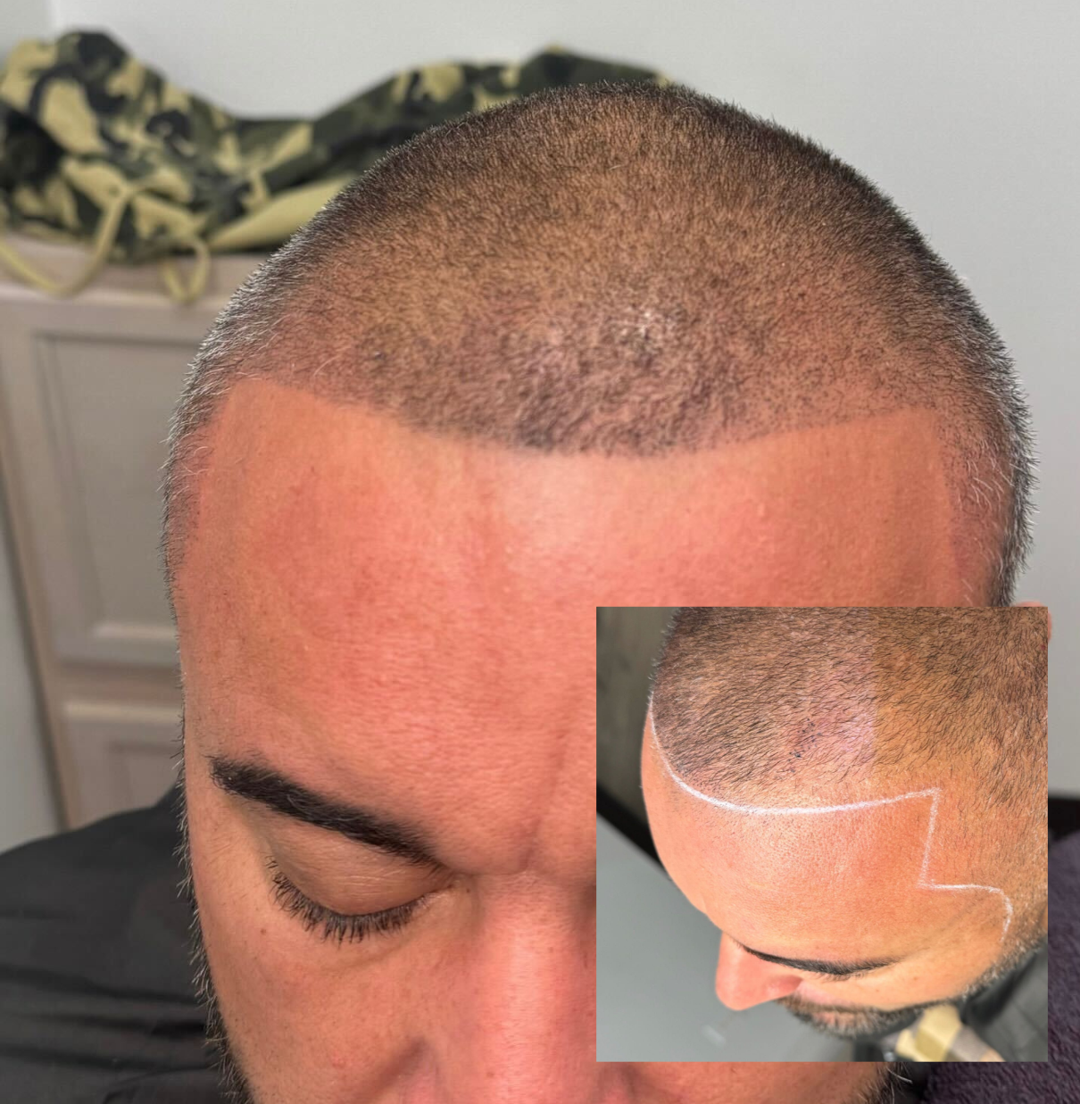 Hairline restoration result